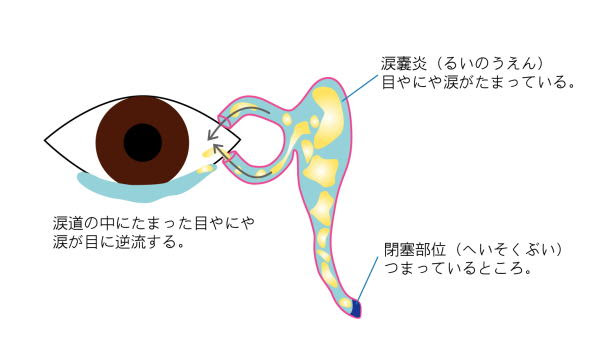 横浜相鉄ビル眼科医院 赤ちゃんの涙目 先天性鼻涙管閉塞 せんてんせいびるいかんへいそく の治療
