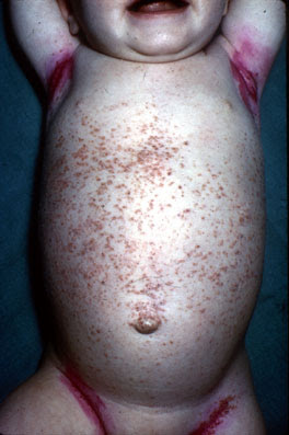 Lsions lmentaires dermatologiques