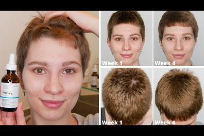 the ordinary hair growth serum reddit