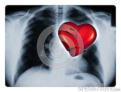 X-Ray Broken Heart Royalty Free Stock Image - Image: 11488366
