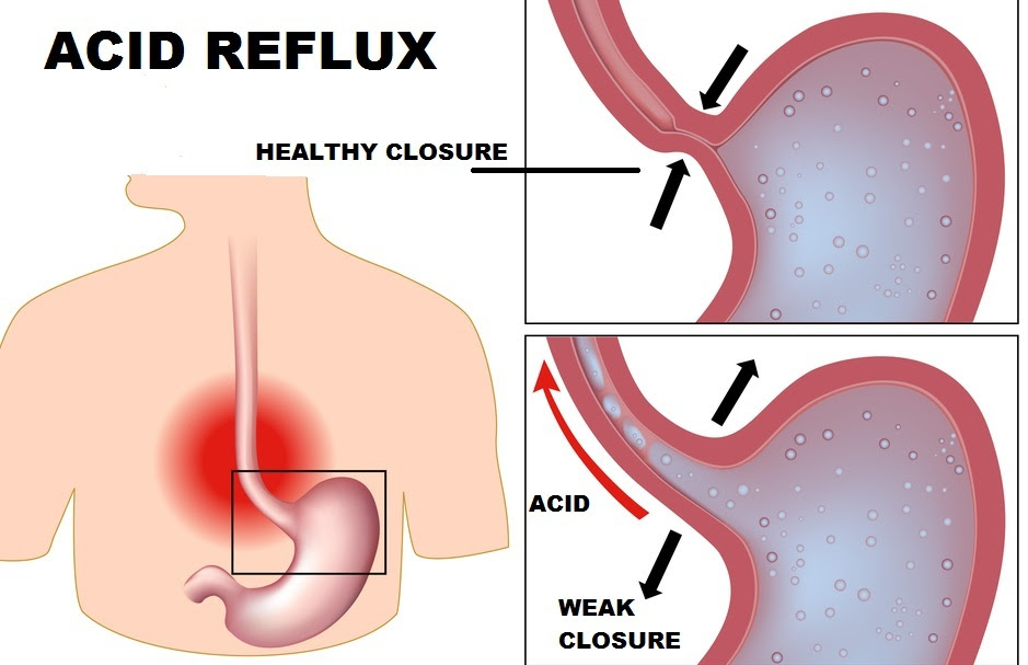 acidreflux
