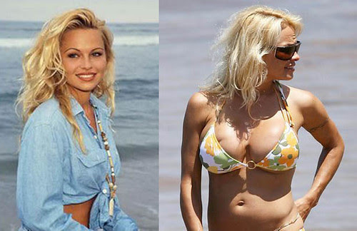 Pamela Anderson - Operasi Plastik