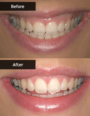 Aesthetic Periodontal Surgery | Burlington Dental Clinic