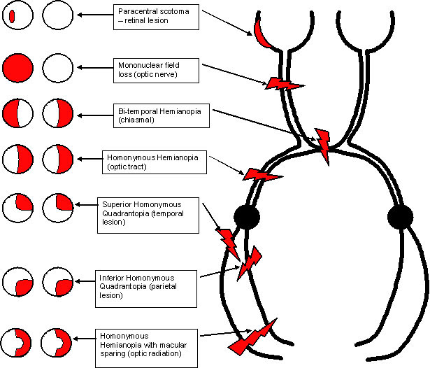 diagram a way 3 for light switch Clinical cranial junior.com cns nerve neurological  Tract Optic