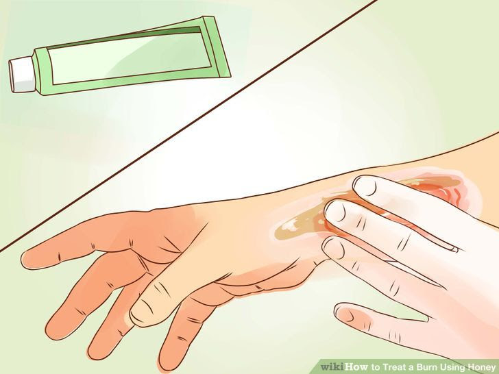 Treat a Burn Using Honey Step 13.jpg