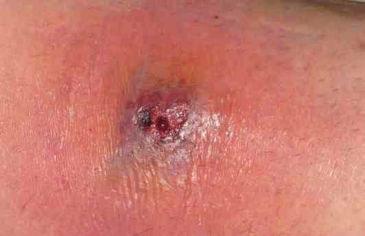 spider bites symptoms. CLICK FOR INFO ON SPIDER BITES