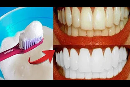 cara menghilangkan karang gigi dengan baking soda