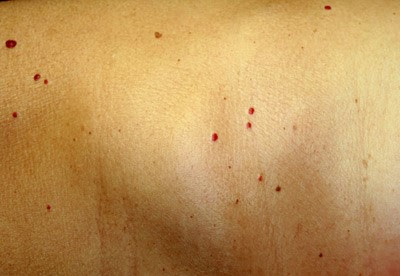 Tiny cherry angioma