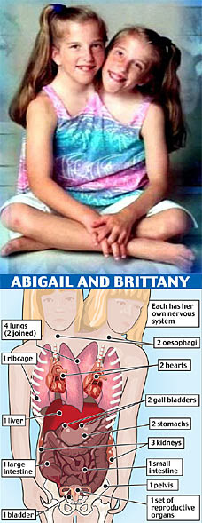 conjoined twins abby and brittany. Abby and Brittany conjoined