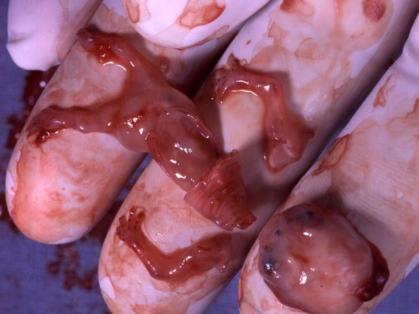 aborted-fetus