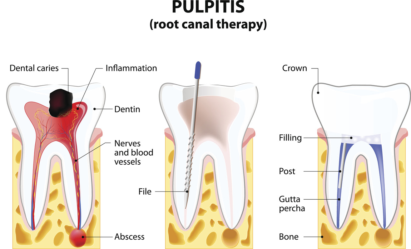 When You Need Root Canal, Dental Implants and Dentures ...