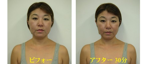 小顔矯正 顎エラ頬の非対称顔歪み専門 関西プロポーション小顔センター大阪梅田院 整体 顎関節症