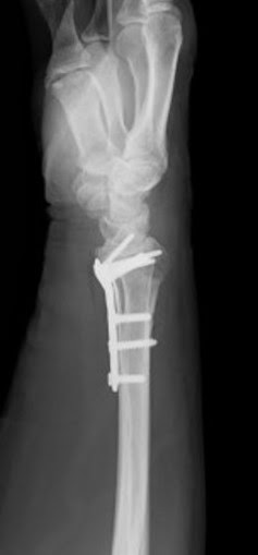手くびの骨折 橈骨 とうこつ 遠位骨折をご存知ですか 済生会小樽病院