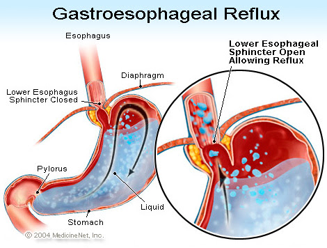 Acid Reflux – Cure Natural Way | Itsnotimpossible