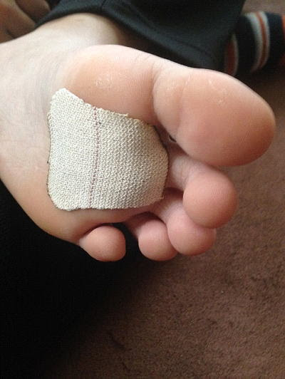 剣道での足のケガ 足の裏の皮がめくれた時のテーピング