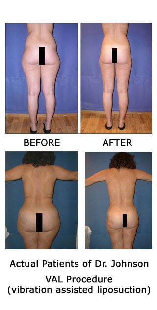 Before And After Velashape Pictures. Before and After Photos of the