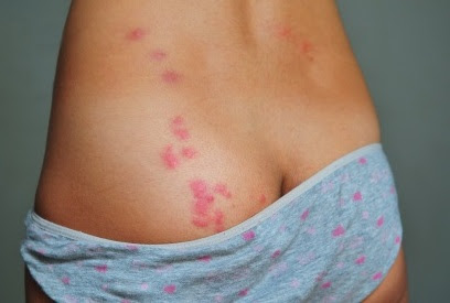 BED BUG PHOTOS | bestpestcontroluk