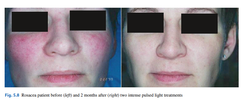 laser per capillari viso