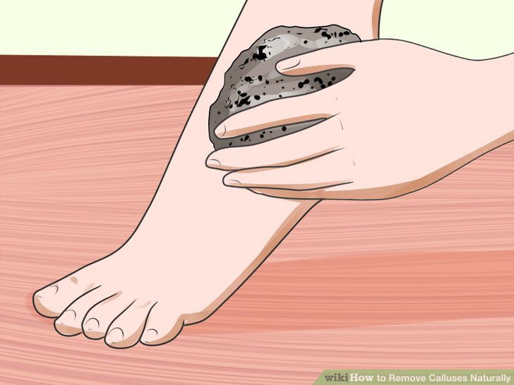Remove Calluses Naturally Step 10 Version 2.jpg