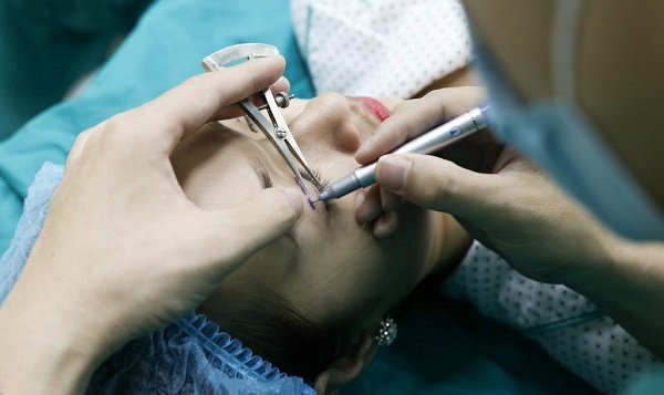 Sau bấm mí mắt có thể tháo ra được không