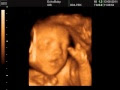 √99以上 photo bebe echographie 3d 239672-Photo bebe echographie 3d