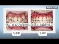 歯並び 悪い 女性 225466-歯��び 悪い 女性