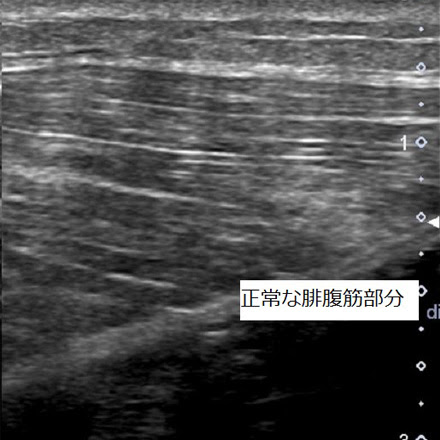 肉離れ 筋挫傷 筋肉内血種 外傷 疾患 フォレスポ フォレスト整形外科スポーツクリニック