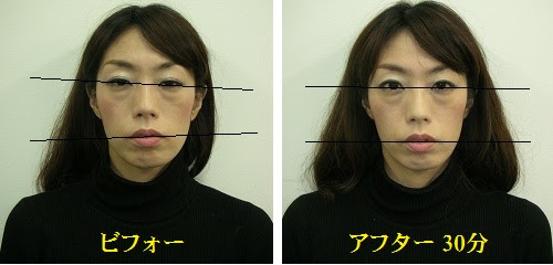 小顔矯正 顔の歪み矯正 ビフォーアフター画像 動画 体験談 関西プロポーション小顔センター大阪梅田院
