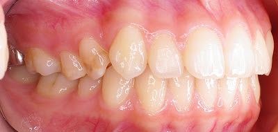 歯の表面が茶色いのは何故 あき歯科医院の医院ブログ