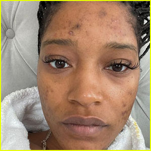 Keke Palmer Gets Candid About Her Battle With Polycystic Ovary Syndrome Pcos Acne Keke Palmer Just Jared