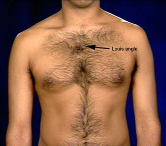 Sternal angle - meddic