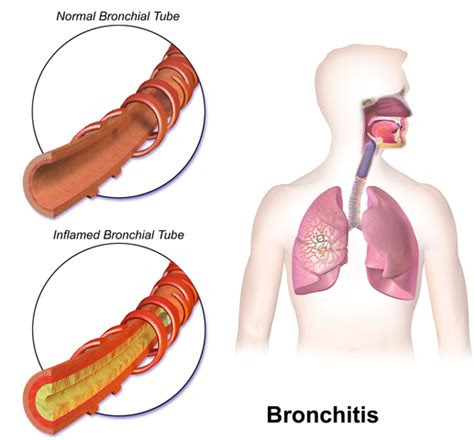 difference  bronchitis  cold difference
