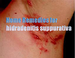 Home Remedies for hidradenitis suppurativa , All Causes, Symptoms, and Treatment of hidradenitis suppurativa , Beauty and Health Tips