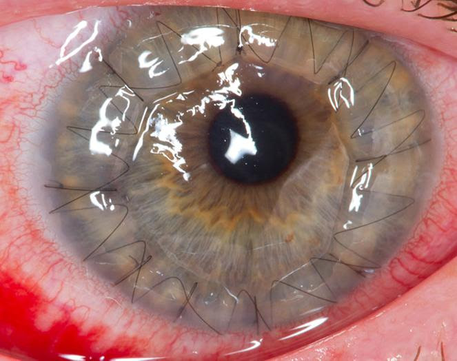 File: Um olho humano 1 dia apÃÂ³s uma cÃÂ³rnea transplant.jpg