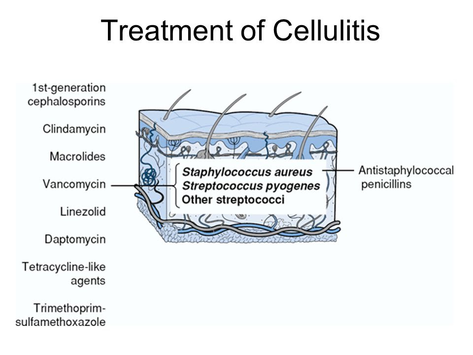 Treatment of Cellulitis