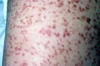 Urticaria pigmentosa.