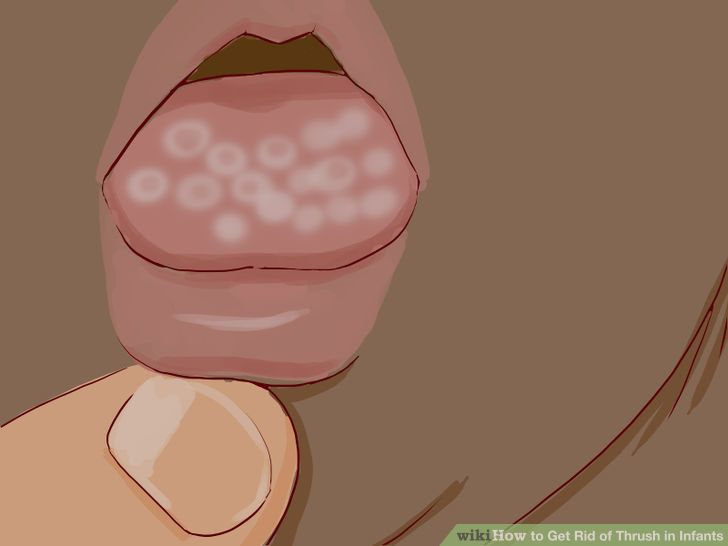 Get Rid of Thrush in Infants Step 12 Version 2.jpg