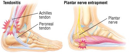 My achilles is swollen