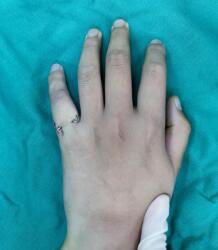 篮球少年暴力抢球 左小指受伤骨折 手外科 徐州仁慈医院 徐州仁慈医疗集团