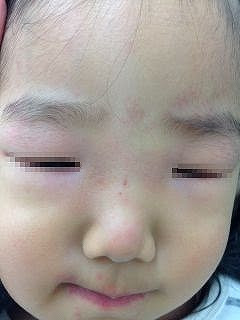 顔のまぶたが腫れている 野田市 小児科 千葉県 こどもの花粉症 こどもの漢方 喘息 アトピー性皮膚炎 アレルギー 結節性痒疹 たんぽぽこどもクリニック