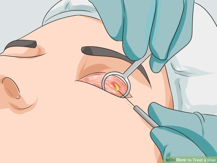 Treat a Stye Step 15 Version 2.jpg