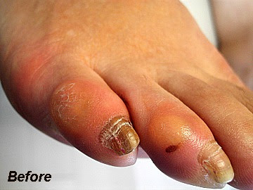 小指の痛いたこ Salon De Liant サロン ド リアン ポドロジー ネイルの莉庵