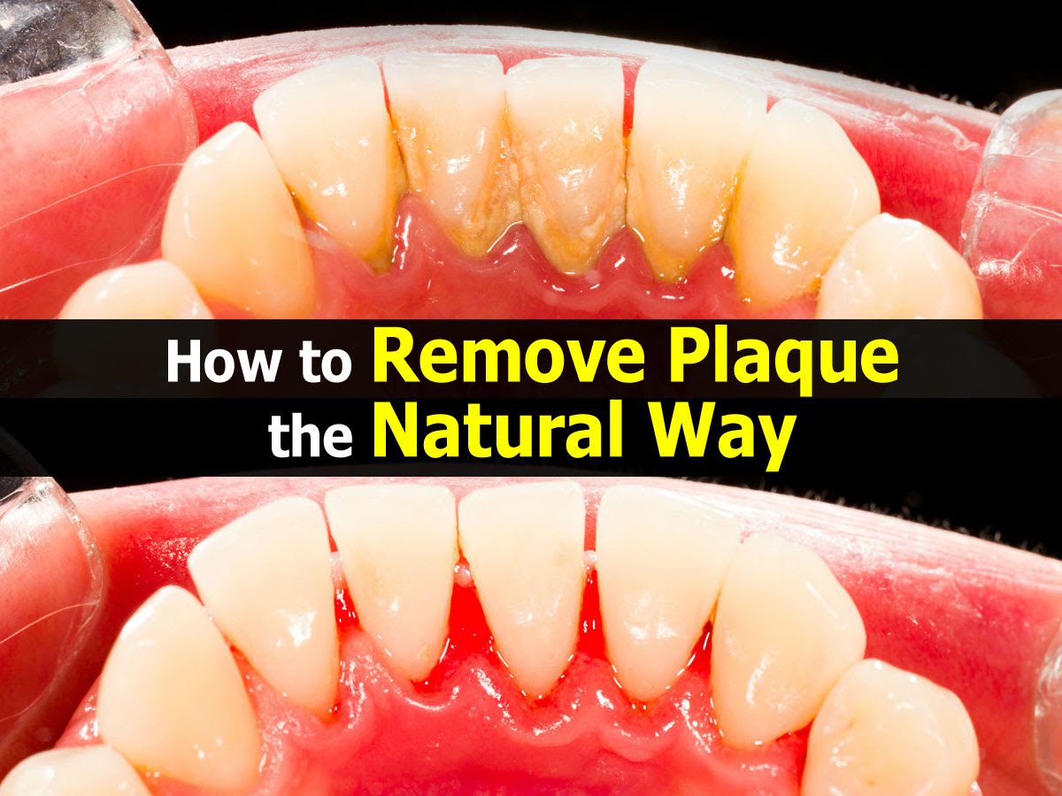 How to Remove Plaque the Natural Way