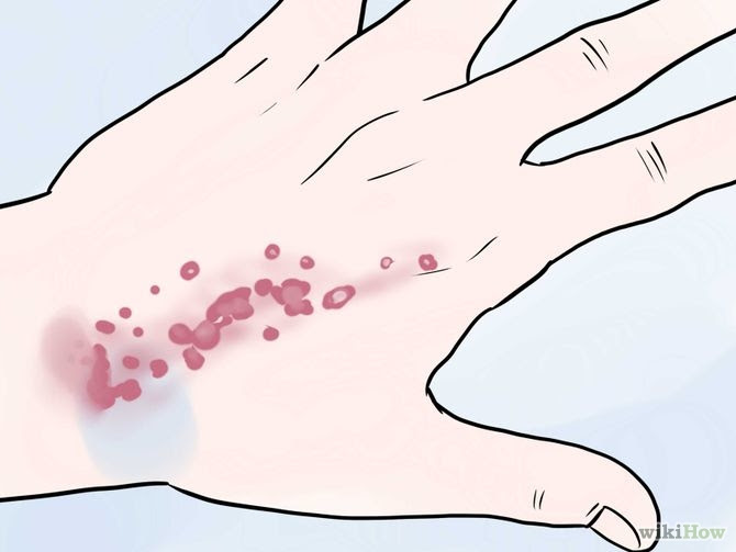 Recognize the Signs of Leukemia Step 5.jpg