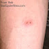 What Do Little Spider Bites Look Like : Spider bites in the us are typically harmless, but know your spider bite symptoms and types of so, what do spider bites look like—and do they itch?