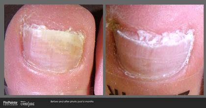 They're even more common among younger populations, with approximately 33% of children and adolescents experiencing warts at some point i. PinPointe Foot Laser - Podiatrist in Wilmette, IL