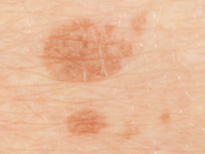 Skin Cancer Symptoms Other Than Moles / Skin cancer scalp with local flap repair - Of course, your specialist is the main person whose advice you should follow but it doesn't do anyone harm.