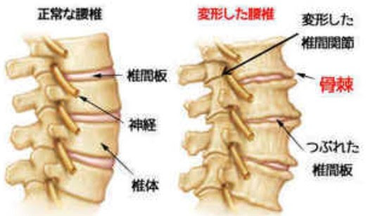 変形性腰椎症と鍼灸治療 横浜市で中国鍼灸 日本鍼灸のハイブリット鍼灸治療なら健康堂中医鍼灸院へ