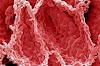 Skin Cancer Under Toenail / Melanoma: Pictures Of Toenail Melanoma