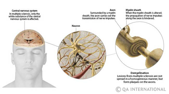 Multiple Sclerosis A Disease Whose Causes Are Unknown Visual Dictionary